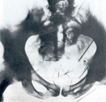 Albert Fish x ray