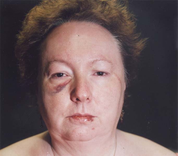 Susan Kuhnhausen after surviving the attack