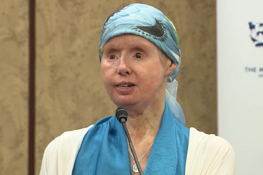 Charla Nash after face transplant